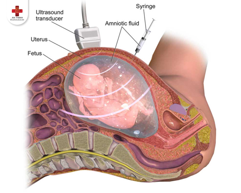 Siêu âm độ mờ da gáy – Xét nghiệm tầm soát phổ biến nhất để chẩn đoán hội chứng Down ở thai nhi (ảnh internet)