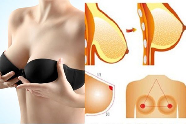 Treo ngực sa trễ - Giải pháp thẩm mỹ hoàn hảo 