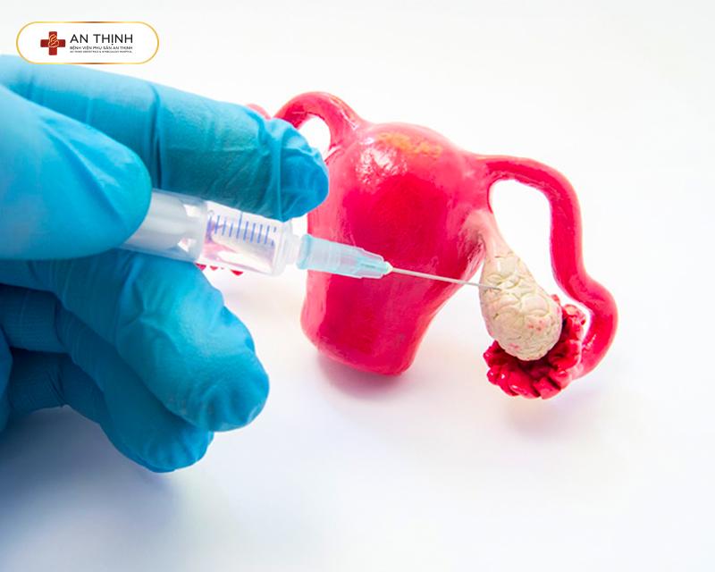 Hội chứng quá kích buồng trứng