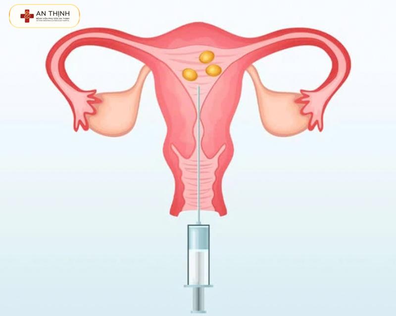 Chọc hút trứng là thủ thuật đơn giản, thời gian phục hồi tùy thể trạng từng người