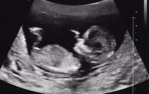 Siêu âm 3 tháng đầu rất quan trọng, giúp bạn biết được có thai hay không