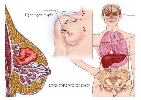 Vị trí khối u vú có thể di căn xa ( não, phổi, gan, xương chậu) theo đường bạch huyết