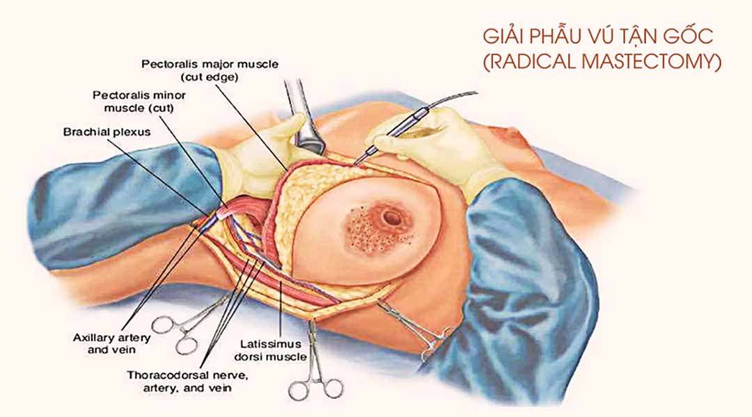 Phẫu thuật cắt bỏ phần thể tích tuyến vú 
