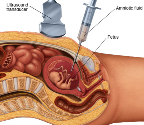 Siêu âm độ mờ da gáy - Xét nghiệm tầm soát phổ biến nhất để chẩn đoán hội chứng Down ở thai nhi 