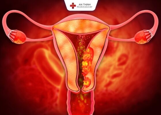 Nội soi tử cung giúp phát hiện các bất thường nội mạc tử cung 